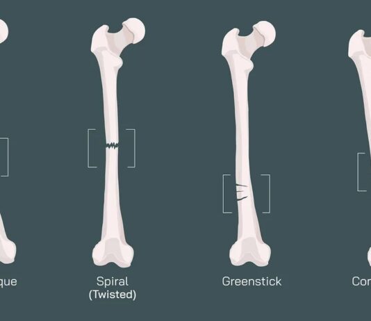 11 типів переломів, які можна виявити на рентгенівському знімку або МРТ